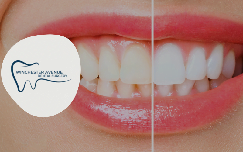 Safe Teeth Whitening at Home Options & Costs Explained