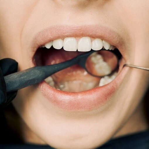 dental fillings in Leicester - winchester avenue dental