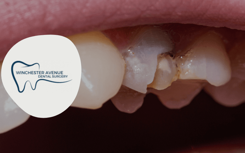 chipped tooth treatment - chipped teeth in Leicester