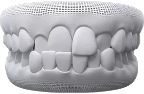 crossbite