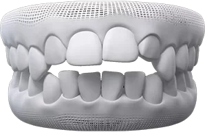 open-bite