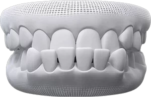 underbite