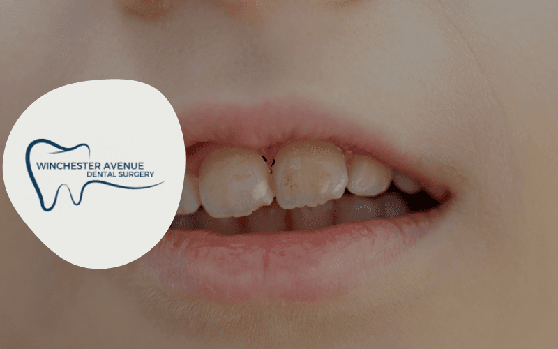 black spots between teeth - dental advice