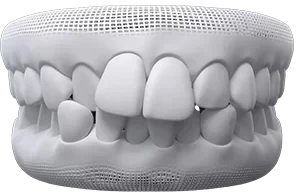 crowded-teeth