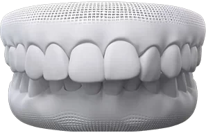 overbite