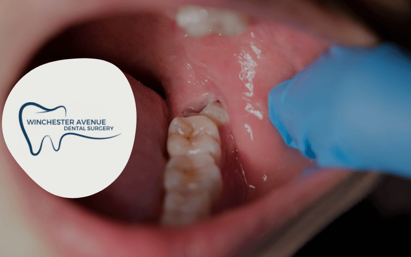 benefits of keeping wisdom teeth_ - photo with half-erupted wisdom tooth