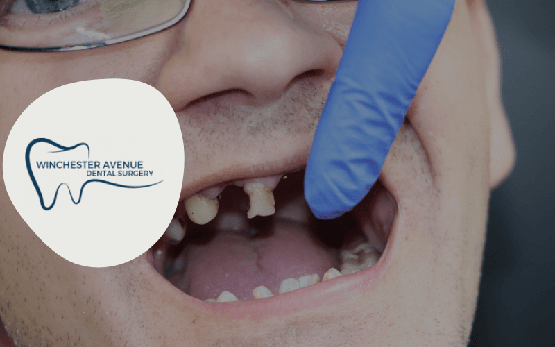 rotten teeth - causes and treatment rotten teeth - causes and treatment