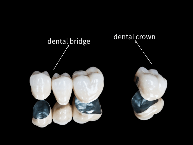dental bridge dental crown leicester