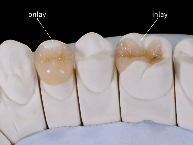 inlay and onlay leicester