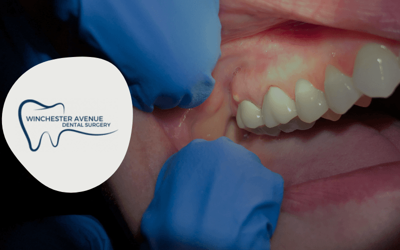 dental abscess